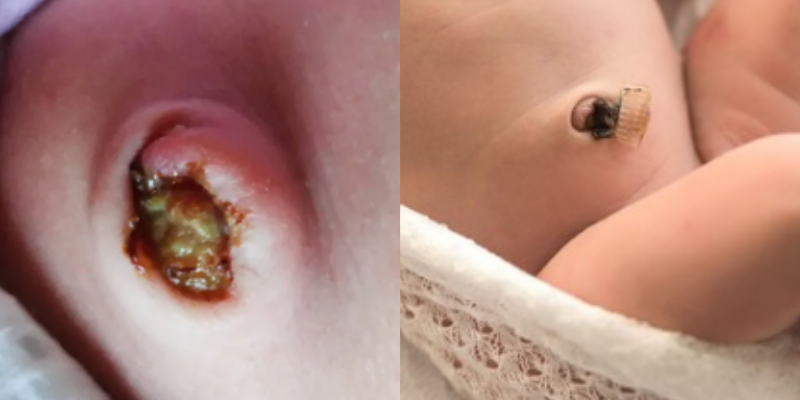 2 images of infected baby belly button